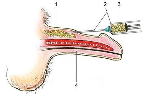 Adipose tissue insert under the skin of the penis