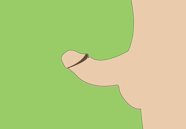 penile curvature as an indication for surgical enlargement